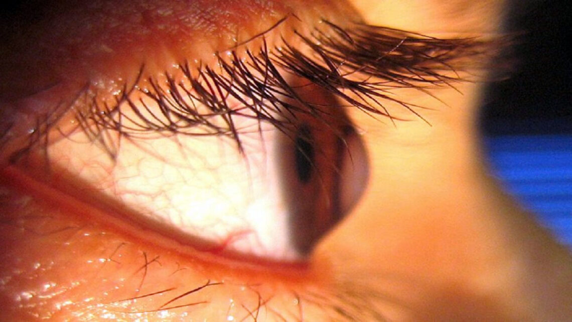 Ceratocone: a ameaça invisível que pode tirar a sua visão Ceratocone: a ameaça invisível que pode tirar a sua visão